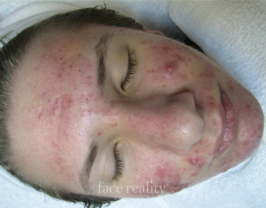 Acne Rosacea causes and treatments