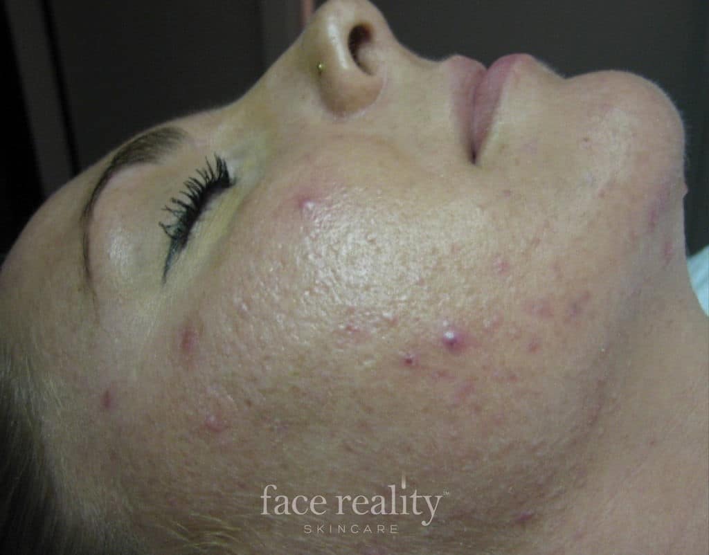 Clear Skin Acne Facial Treatments Shelton WA